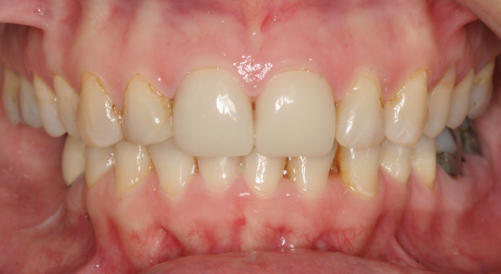 Adult-treatment-deep-bite-and-cross-bite-1-after