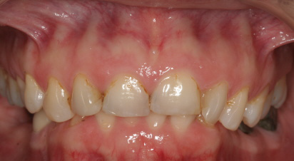 Adult-treatment-deep-bite-and-cross-bite-1-before