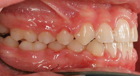 Class-2-bite-flared-teeth-after