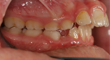 Class-2-bite-flared-teeth-before