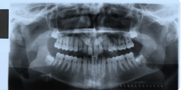 Impacted-canies-xray1