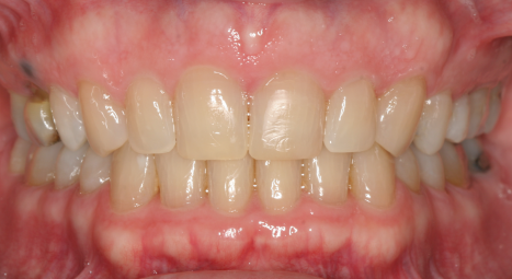 adult-spacing-deep-bite-after
