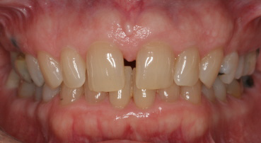 adult-spacing-deep-bite-before