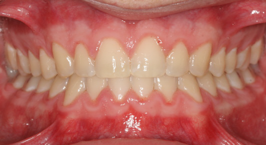 underbite-crossbite-after