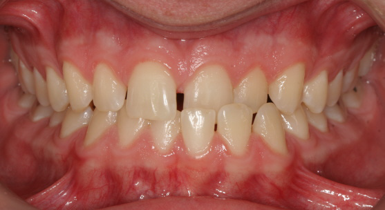 underbite-crossbite-before